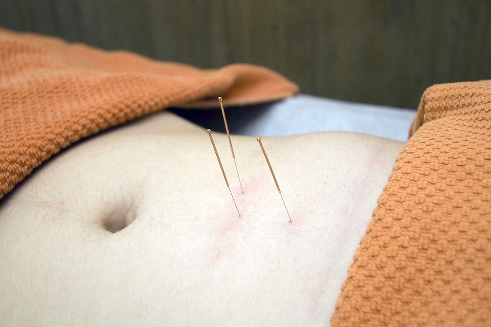 acupuncture in St. James
